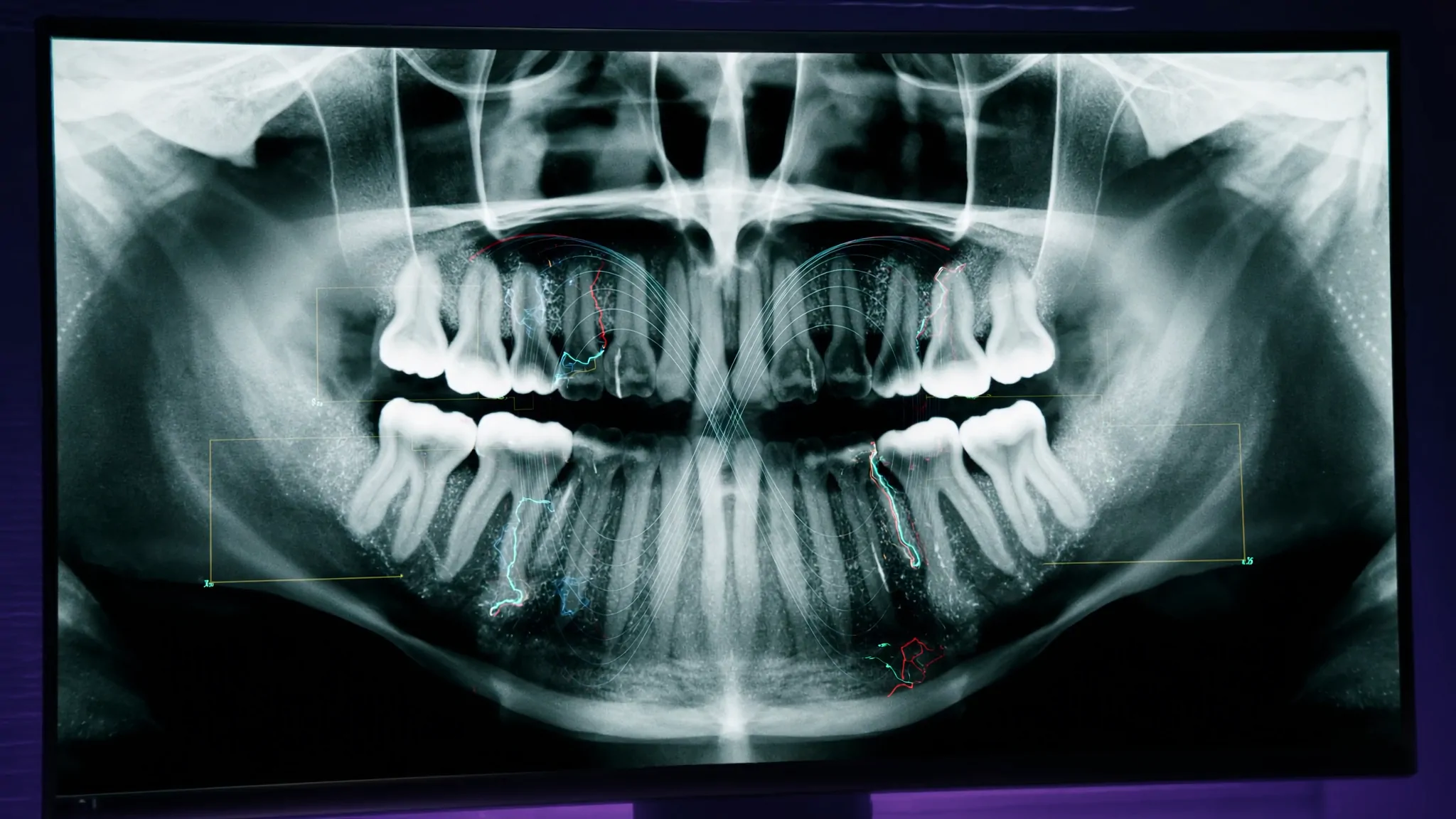 Radiografía panorámica dental con anotaciones de inteligencia artificial en pantalla de diagnóstico